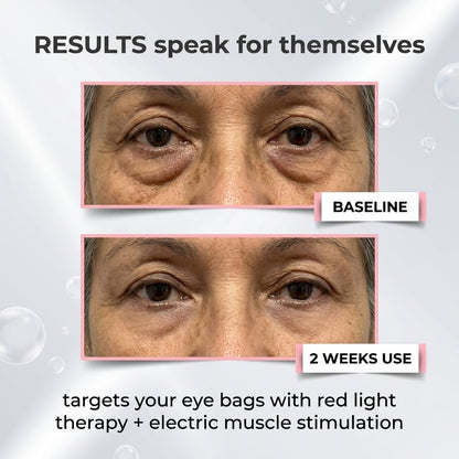 AuraEyes™ 2 en 1: Terapia de luz roja + EMS para reducir las bolsas bajo los ojos