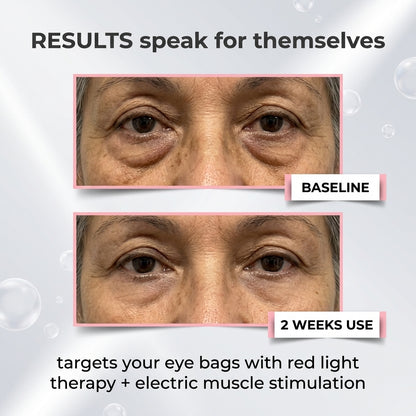 AuraEyes™ 2-in-1: Roodlichttherapie + EMS om wallen onder de ogen te verminderen