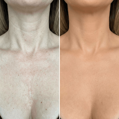 SkinPerfect™